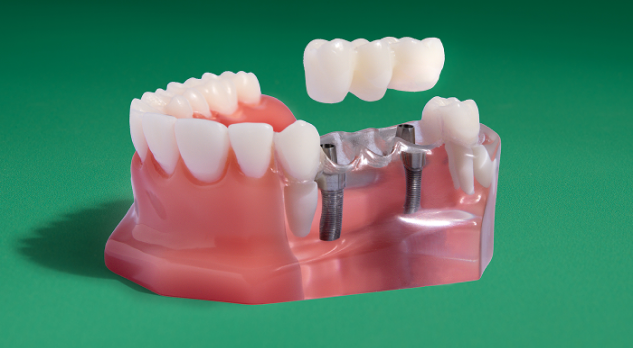 Implant bridge model