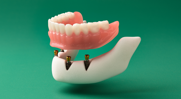 Implant dentures model