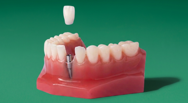 Single tooth implant model